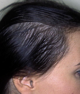 Do steroid injections for alopecia work