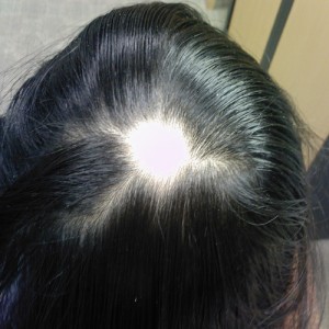 Hair Loss in Women, Alopecia Areata