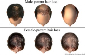 Hair Loss in Women and Men