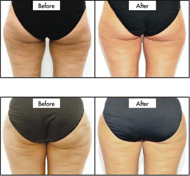 Cellulite: The Facts, The Myths and Best Ways to Treat It ...