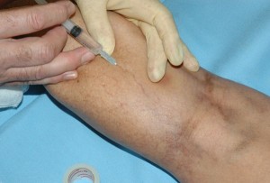 Varicose Veins